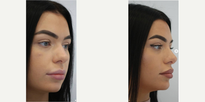 Nonsurgical Nose Job before and after photo