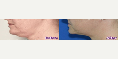 Dermal Fillers before and after photo