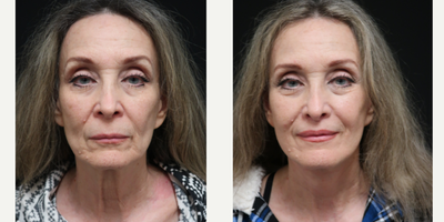 Facelift before and after photo