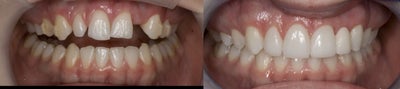 Lumineers before and after photo