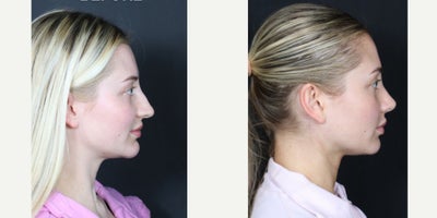 Rhinoplasty before and after photo