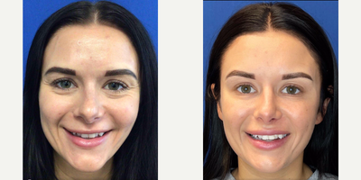 Eyelid Surgery before and after photo