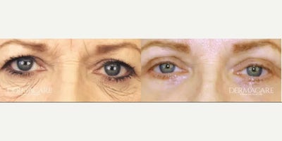 Eyelid Surgery before and after photo