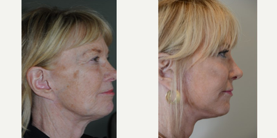 Facelift before and after photo