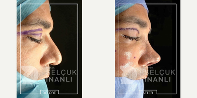 Facial Fat Transfer before and after photo