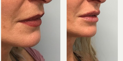 Lip Fillers before and after photo