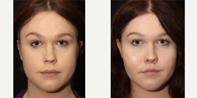 Buccal Fat Removal before and after photo