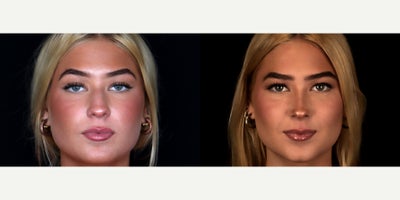 Rhinoplasty before and after photo