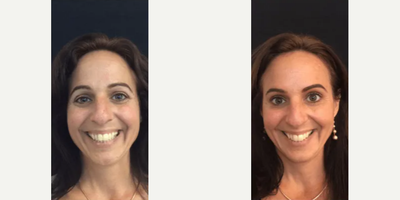 Botox before and after photo
