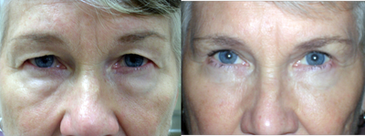 Eyelid Surgery before and after photo