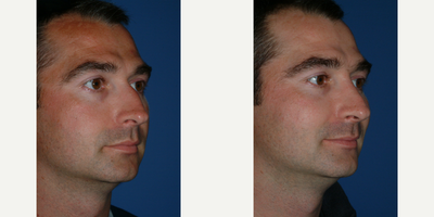 Rhinoplasty before and after photo