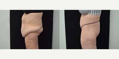 Body Lift before and after photo