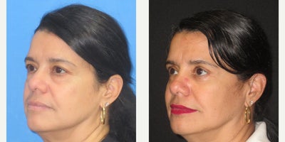 Eyelid Surgery before and after photo