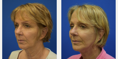 Facelift before and after photo