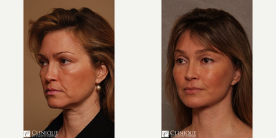 Facial Fat Transfer before and after photo