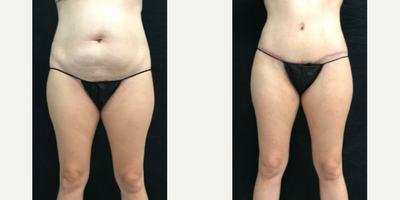 Mommy Makeover before and after photo