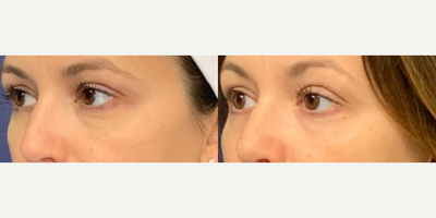 Skin Rejuvenation before and after photo