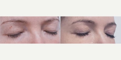 Fractional Laser before and after photo