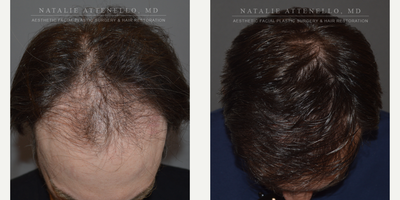 Hair Transplant before and after photo