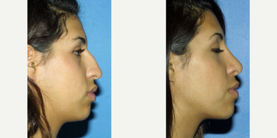Rhinoplasty before and after photo