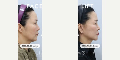 Facial Fat Transfer before and after photo