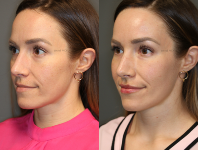 Laser Resurfacing before and after photo