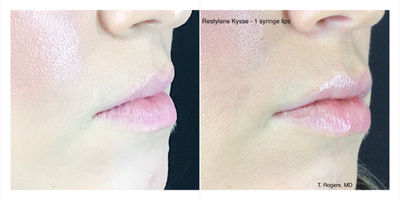 Restylane before and after photo