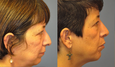 Revision Rhinoplasty before and after photo