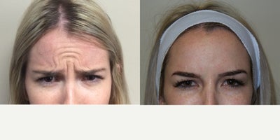 Botox before and after photo