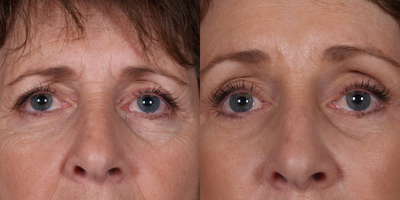 Brow Lift before and after photo