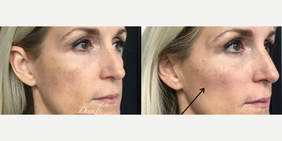 Cheek Augmentation before and after photo