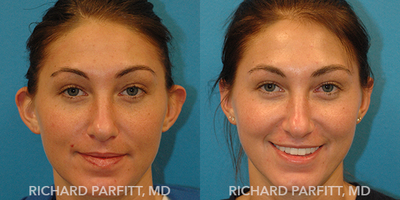 Ear Surgery before and after photo