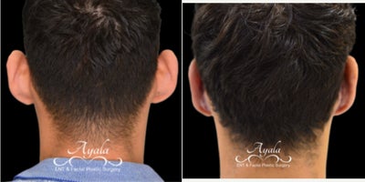 Ear Surgery before and after photo
