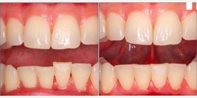 Invisalign before and after photo
