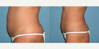Liposuction before and after photo