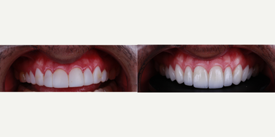 Smile Makeover before and after photo
