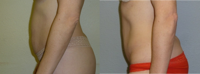 Tummy Tuck before and after photo