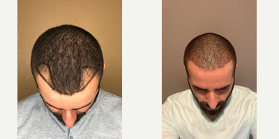 ARTAS Robotic Hair Transplant before and after photo