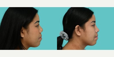 Asian Rhinoplasty before and after photo