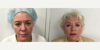 Eyelid Surgery before and after photo