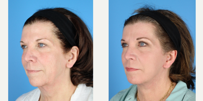 Facelift before and after photo