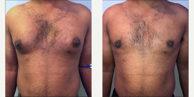 Gynecomastia Surgery before and after photo