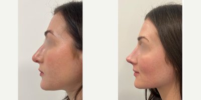 Rhinoplasty before and after photo
