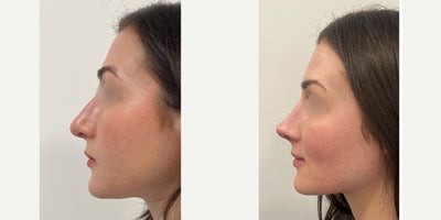 Rhinoplasty before and after photo