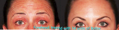 Botox before and after photo
