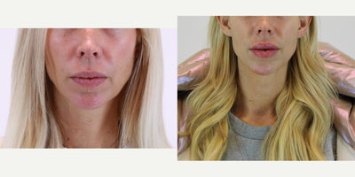 Dermal Fillers before and after photo