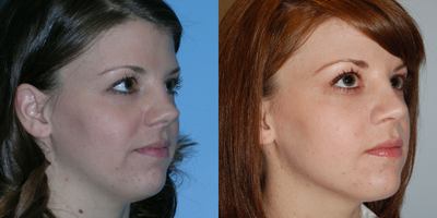 Rhinoplasty before and after photo