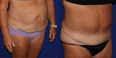 Tummy Tuck before and after photo