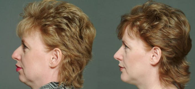 Chin Implant before and after photo