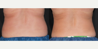 CoolSculpting before and after photo